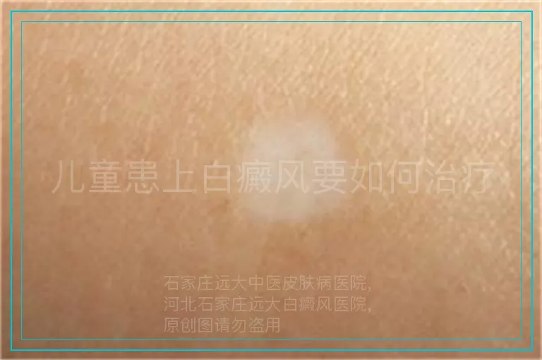 儿童患上白癜风要如何治疗
