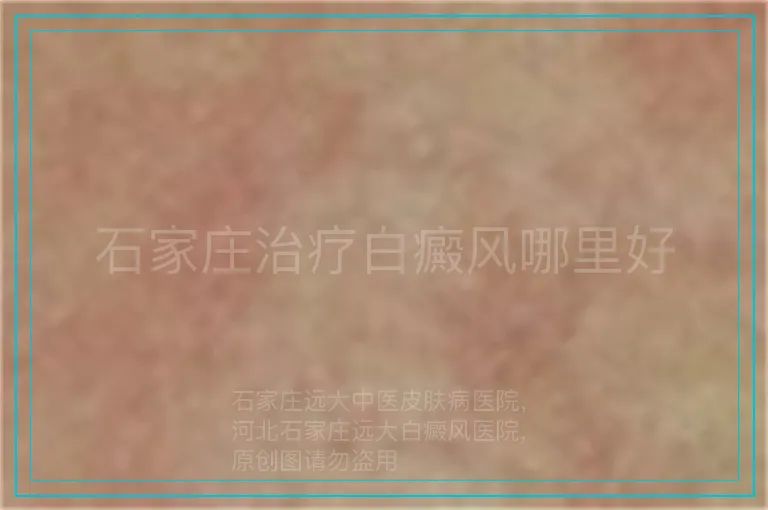 石家庄治疗白癜风哪里好
