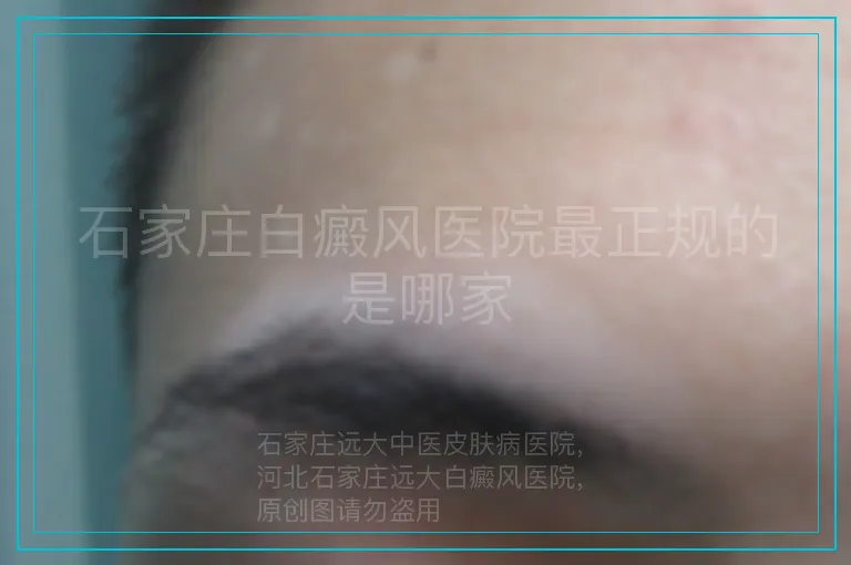 石家庄白癜风医院最正规的是哪家