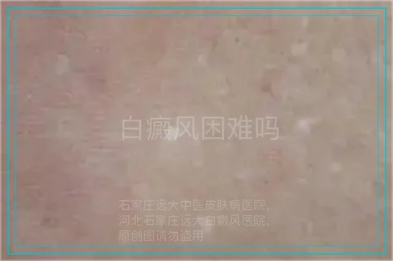 白癜风困难吗