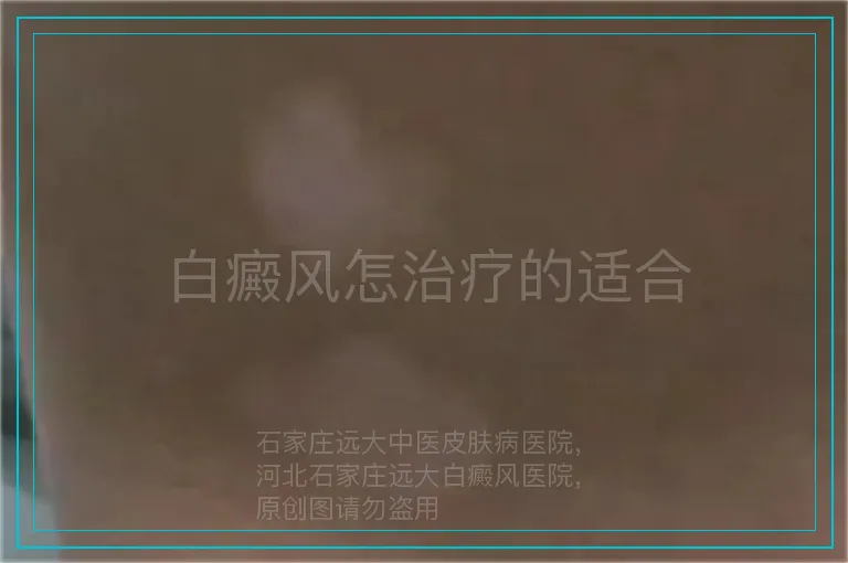 白癜风怎治疗的适合