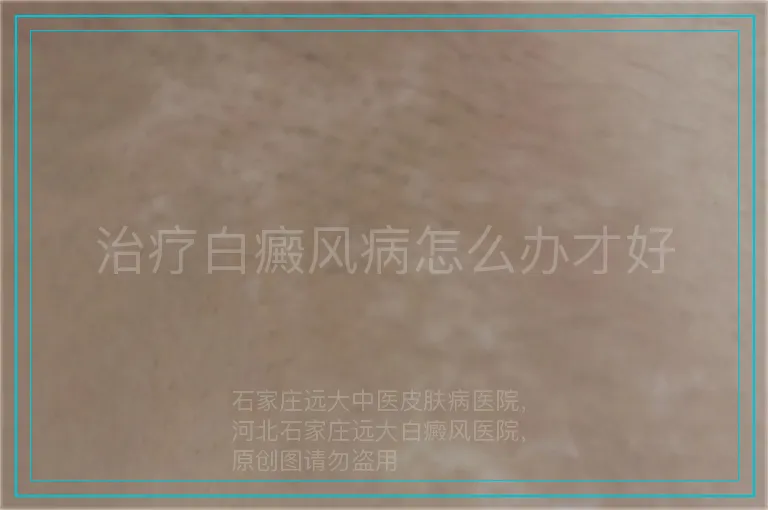 治疗白癜风病怎么办才好