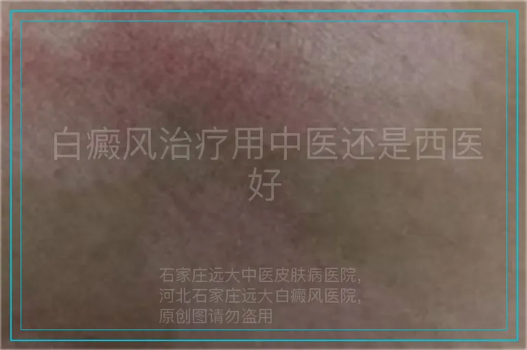 白癜风治疗用中医还是西医好