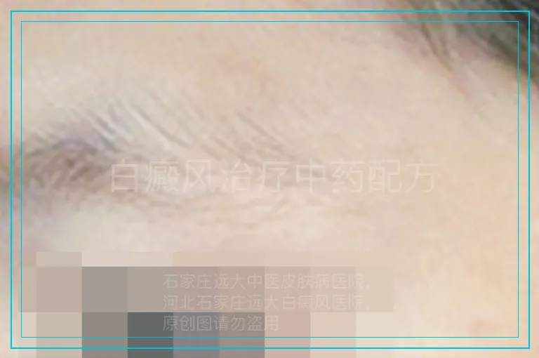 白癜风治疗中药配方