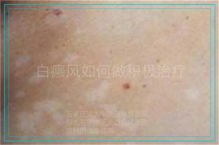 白癜风如何做积极治疗