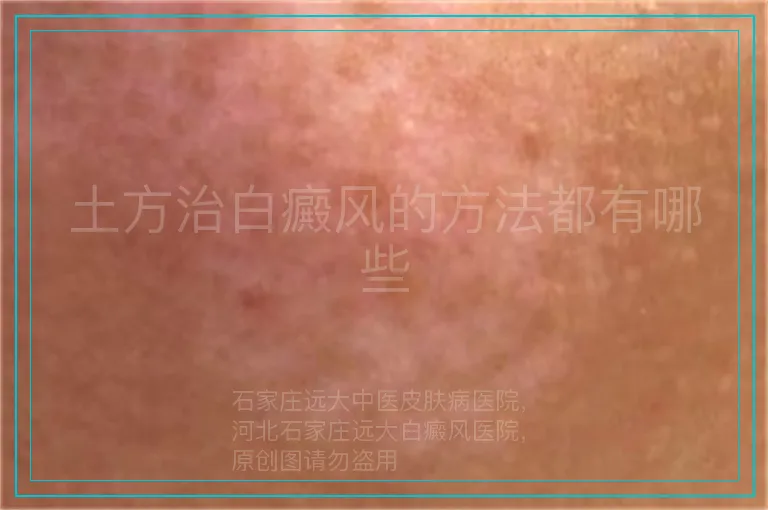 土方治白癜风的方法都有哪些
