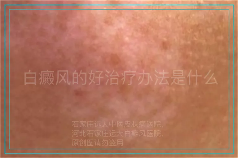 白癜风的好治疗办法是什么