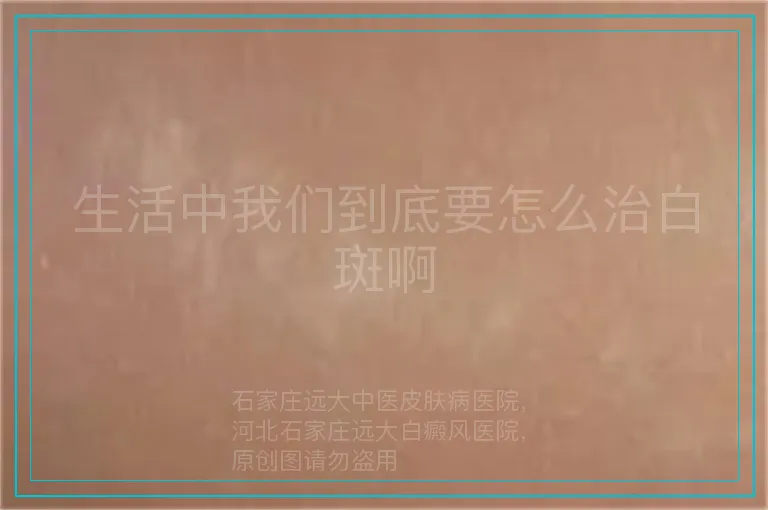 生活中我们到底要怎么治白斑啊