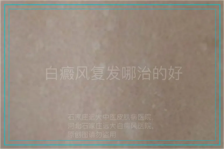 白癜风复发哪治的好