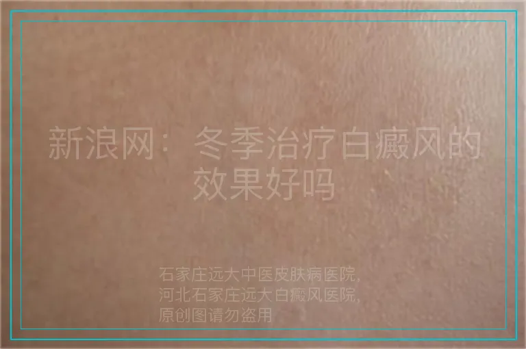 新浪网:冬季治疗白癜风的效果好吗
