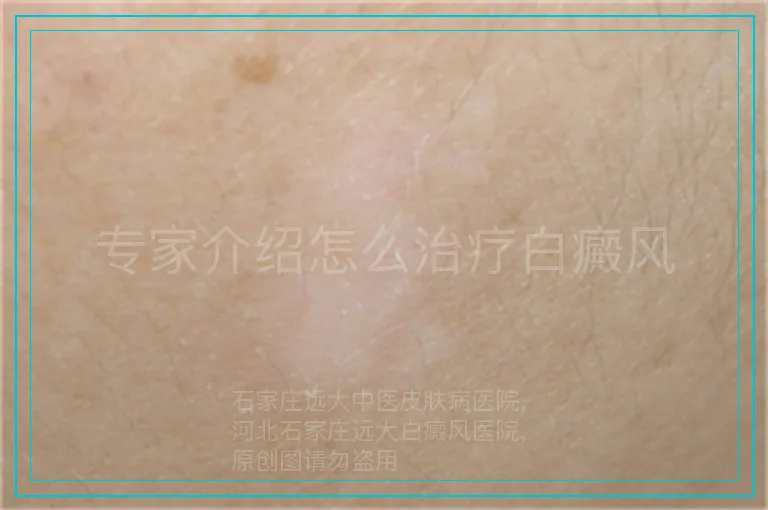 专家介绍怎么治疗白癜风