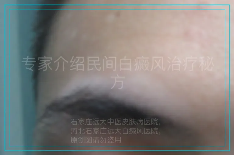 专家介绍民间白癜风治疗秘方
