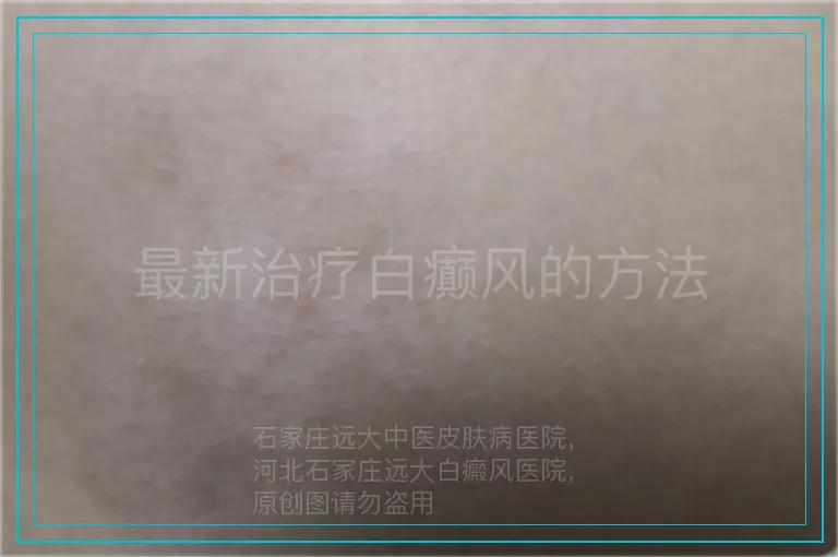 最新治疗白癫风的方法