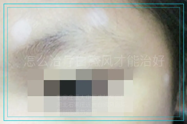 怎么治疗白癜风才能治好