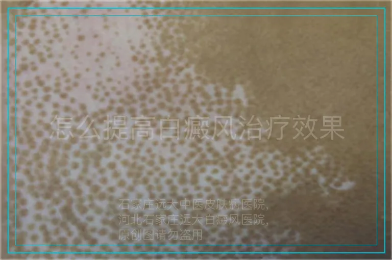 怎么提高白癜风治疗效果