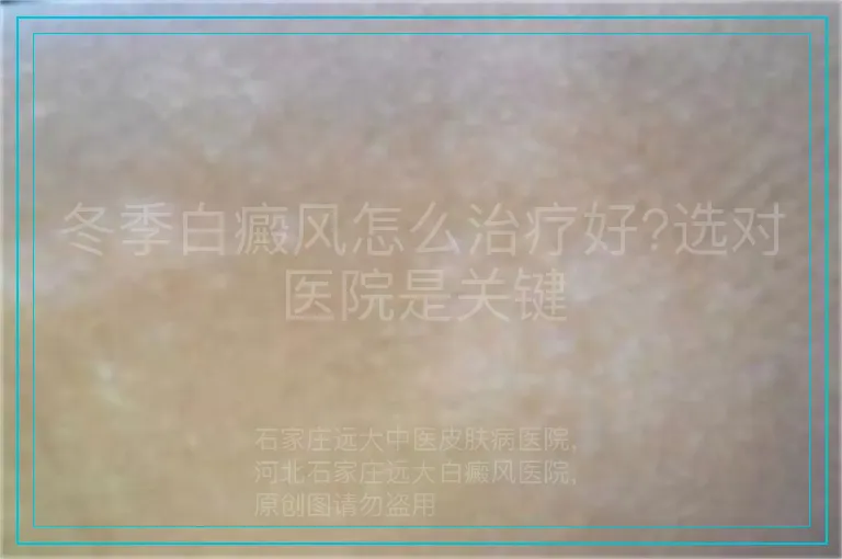 冬季白癜风怎么治疗好?选对医院是关键