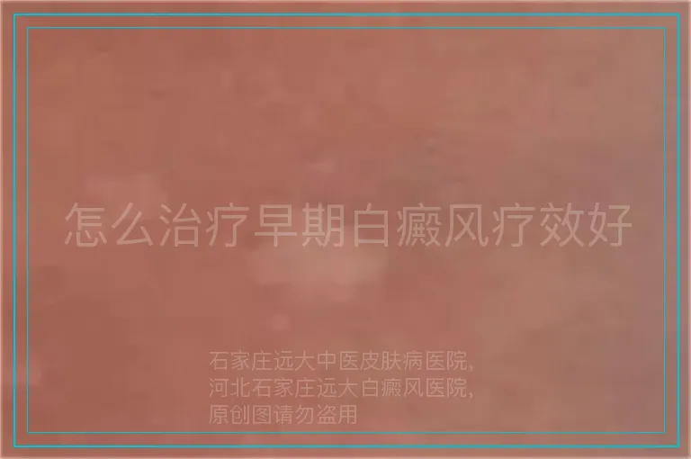 怎么治疗早期白癜风疗效好
