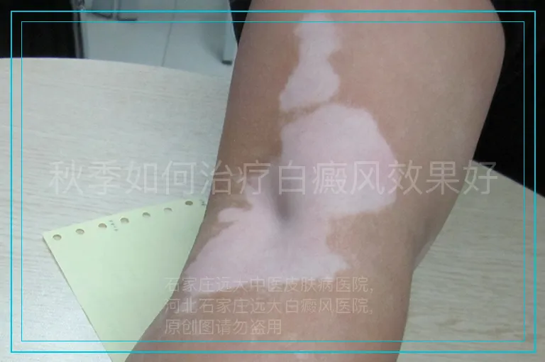 秋季如何治疗白癜风效果好