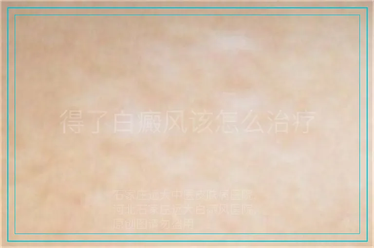 得了白癜风该怎么治疗