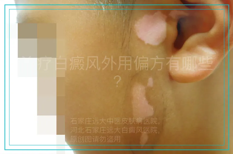 治疗白癜风外用偏方有哪些?