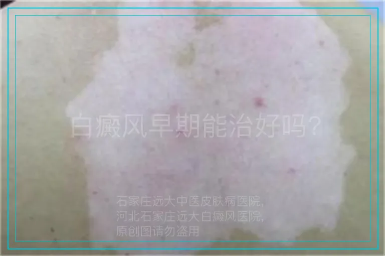 白癜风早期能治好吗?