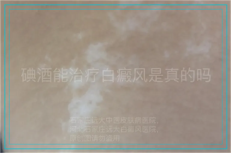 碘酒能治疗白癜风是真的吗