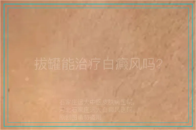 拔罐能治疗白癜风吗?