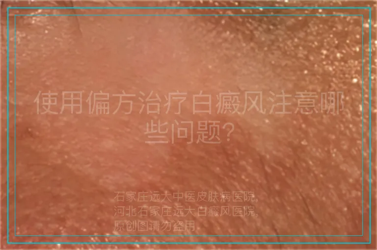 使用偏方治疗白癜风注意哪些问题?