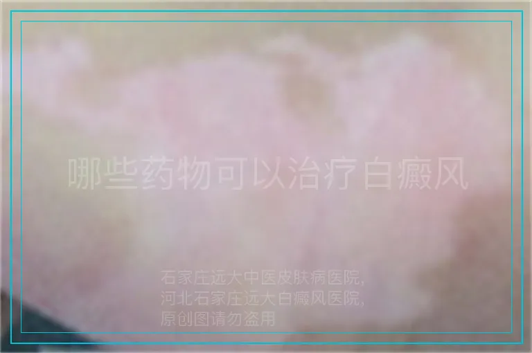 哪些药物可以治疗白癜风