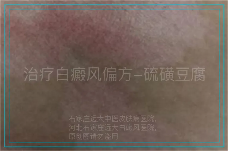 治疗白癜风偏方-硫磺豆腐