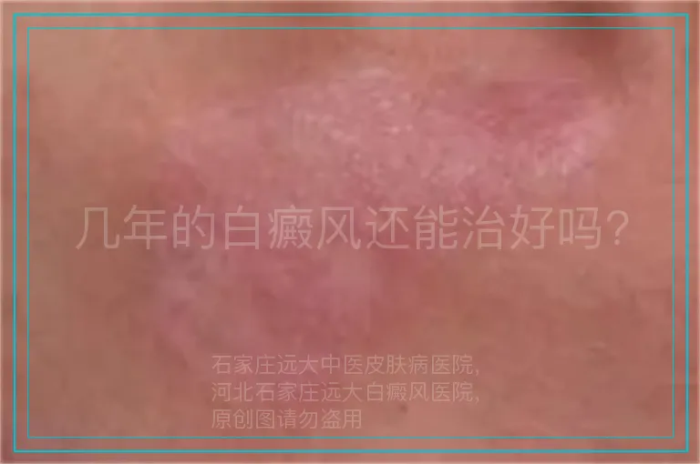 几年的白癜风还能治好吗?