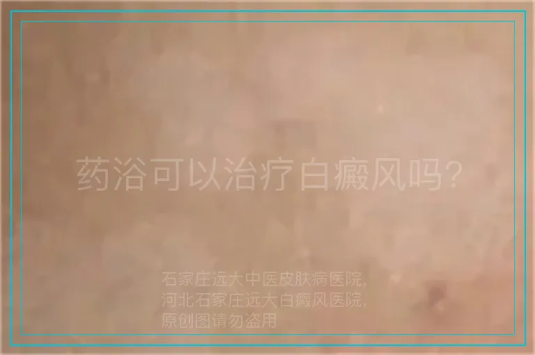 药浴可以治疗白癜风吗?