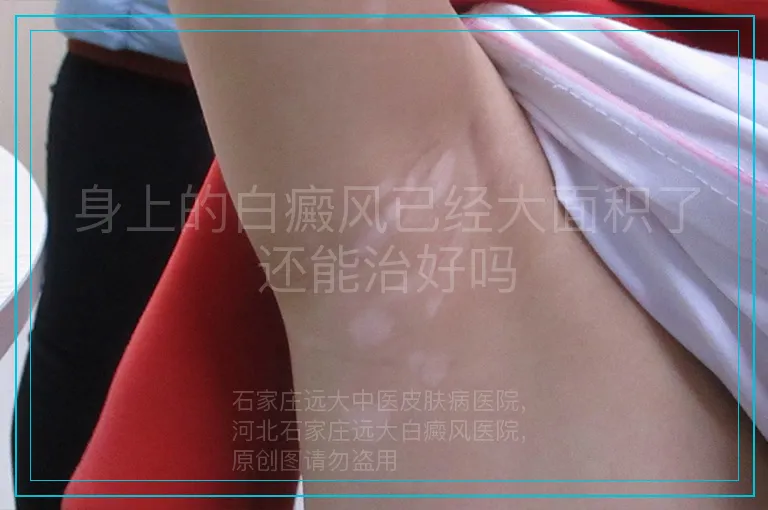 身上的白癜风已经大面积了还能治好吗