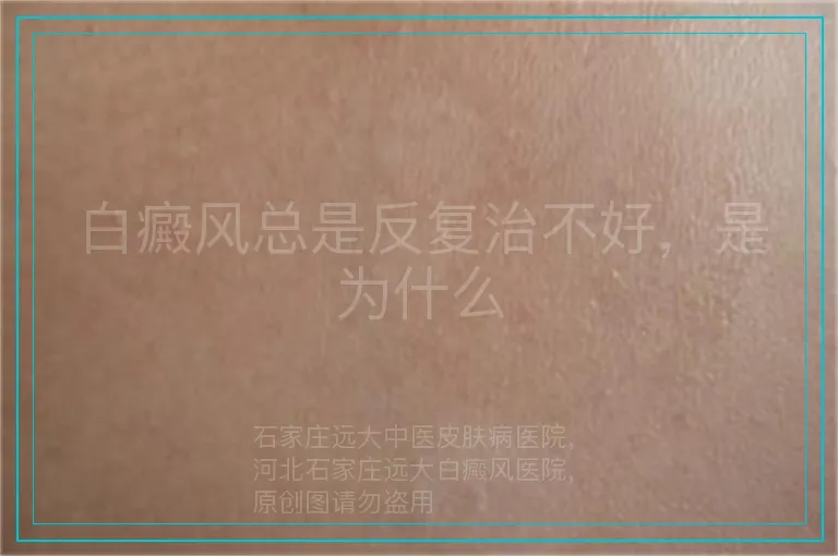 白癜风总是反复治不好,是为什么