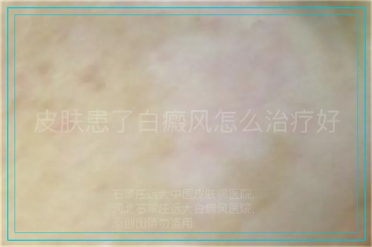 皮肤患了白癜风怎么治疗好