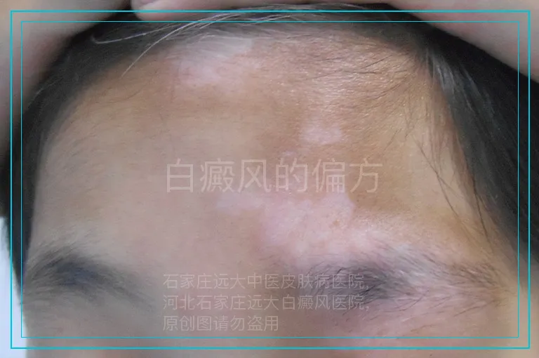 白癜风的偏方