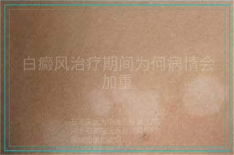 白癜风治疗期间为何病情会加重