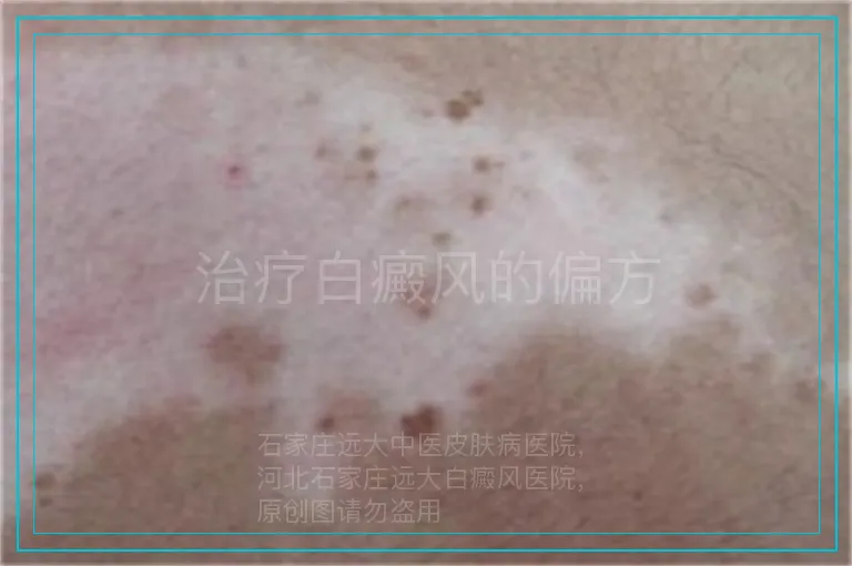治疗白癜风的偏方