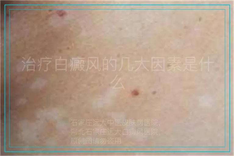 治疗白癜风的几大因素是什么