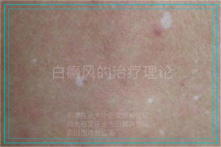 白癜风的治疗理论