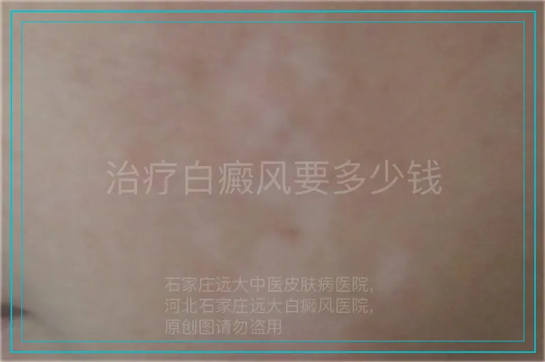 治疗白癜风要多少钱