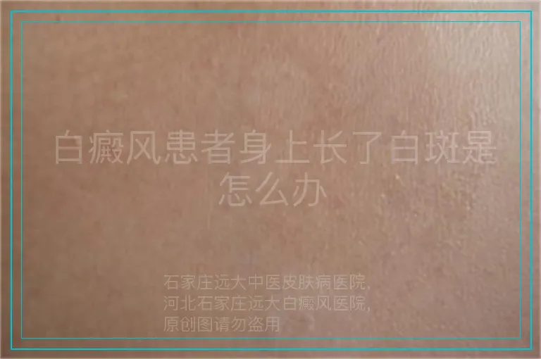 白癜风患者身上长了白斑是怎么办