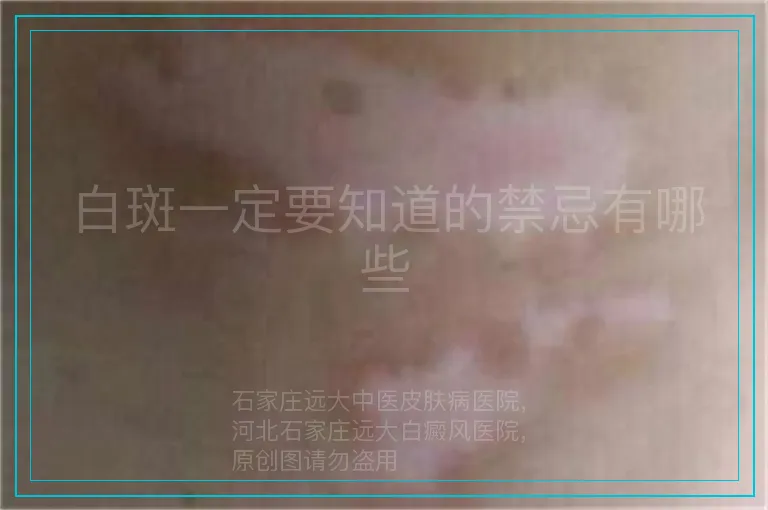 白斑一定要知道的禁忌有哪些