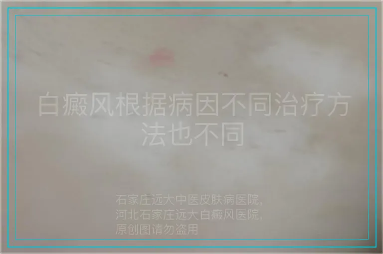 白癜风根据病因不同治疗方法也不同