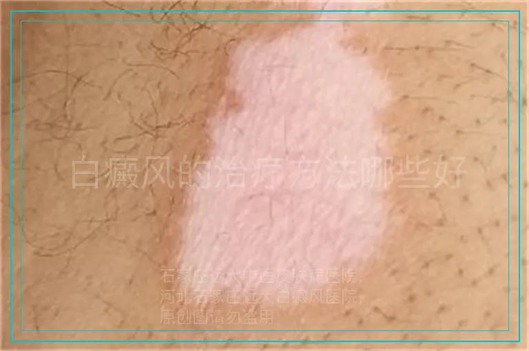 白癜风的治疗方法哪些好