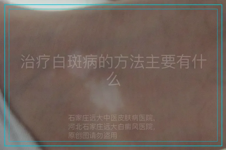 治疗白斑病的方法主要有什么