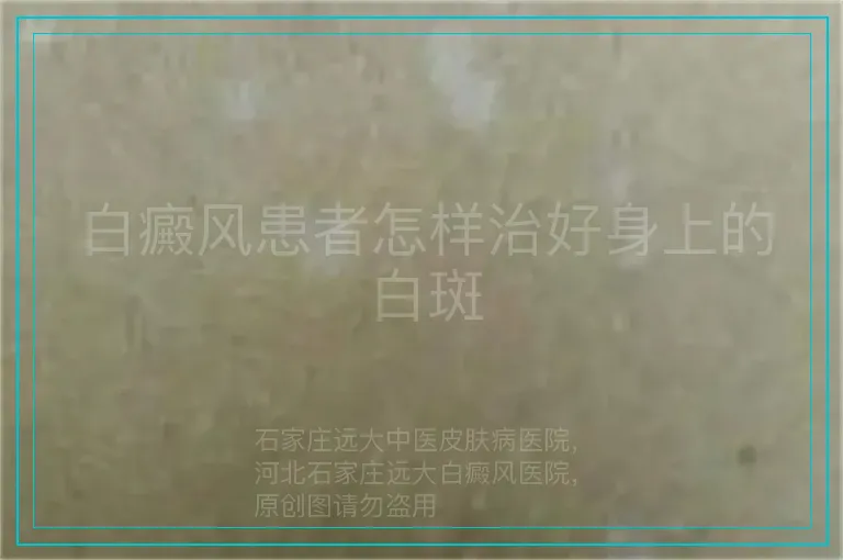 白癜风患者怎样治好身上的白斑