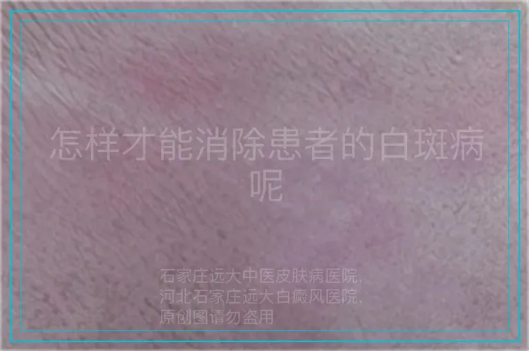 怎样才能消除患者的白斑病呢