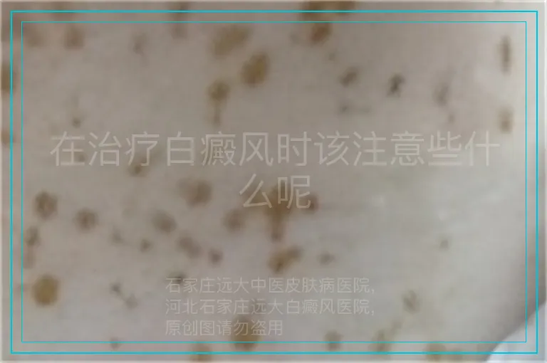 在治疗白癜风时该注意些什么呢