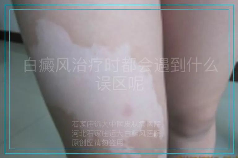 白癜风治疗时都会遇到什么误区呢